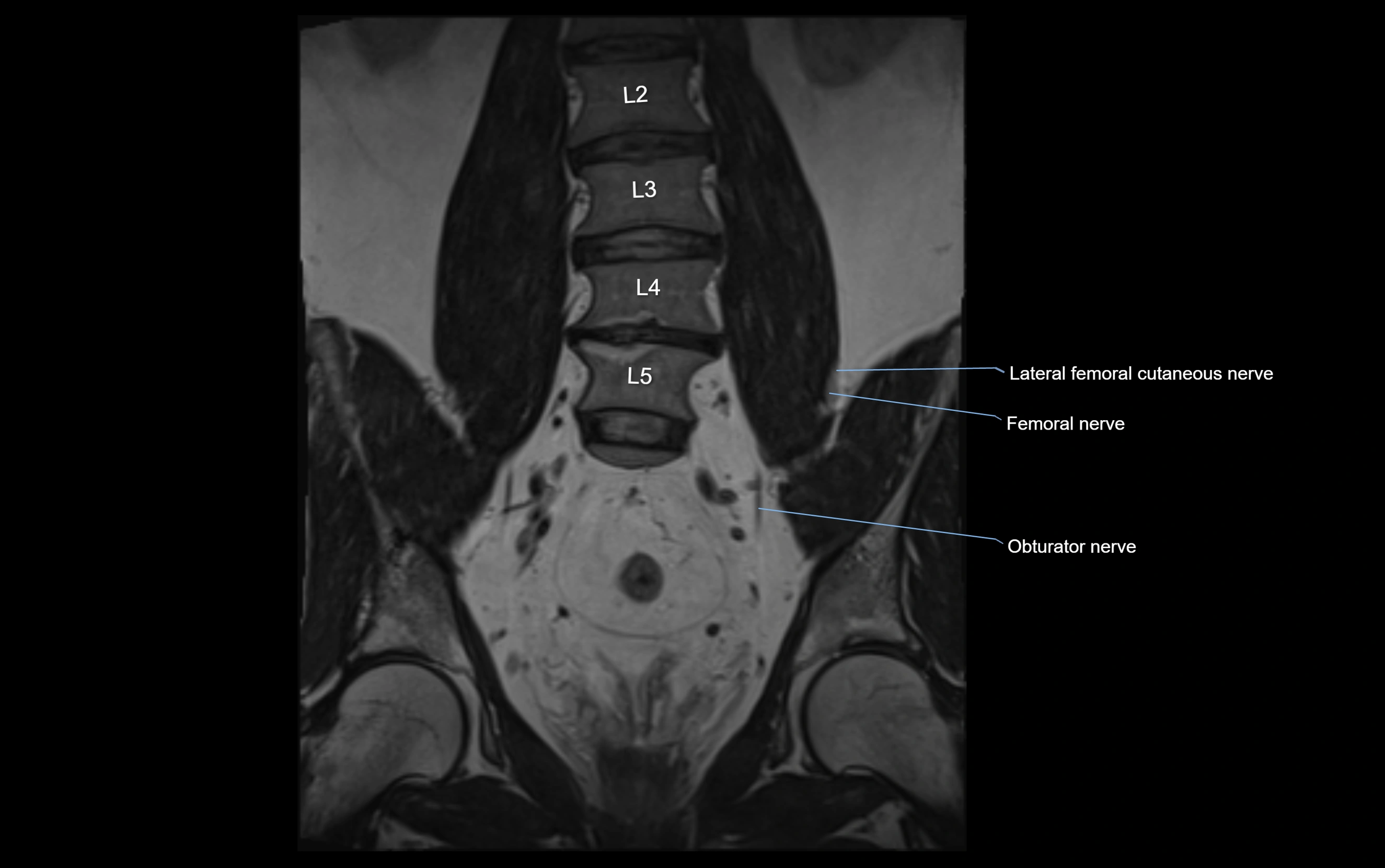 MR lumbosacral plexus cross sectional anatomy 3T  radiology  image-img-09001-00025.webp